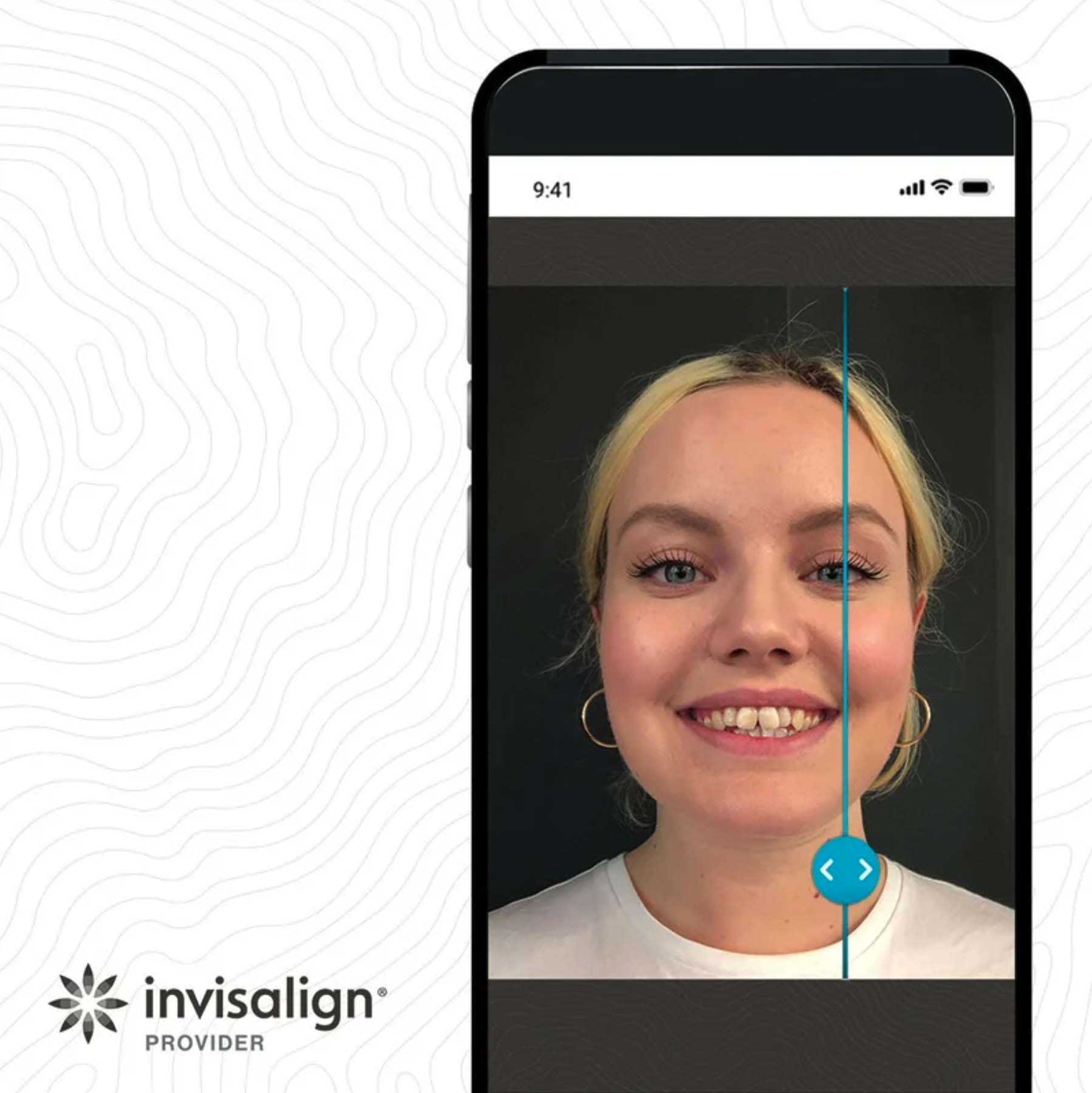 Invisalign Smile Simulation At Mi Smiles Dental
