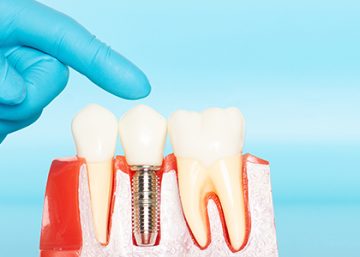 Dental implant dentists in West Michigan